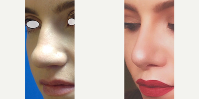 Rhinoplasty before and after photo