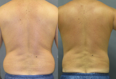 Liposuction before and after photo