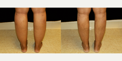 Liposuction before and after photo