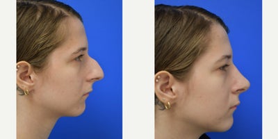 Rhinoplasty before and after photo