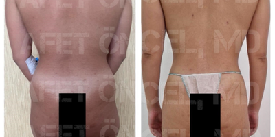 Vaser Liposuction before and after photo