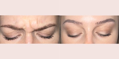 Botox before and after photo