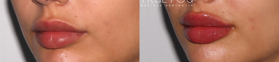 Lip Fillers before and after photo