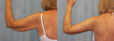 Arm Lift before and after photo