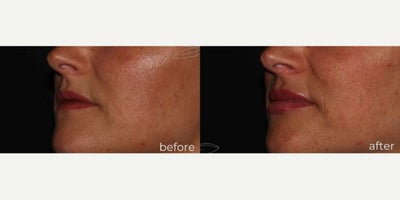 Dermal Fillers before and after photo