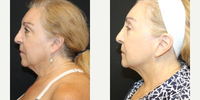 Facelift before and after photo