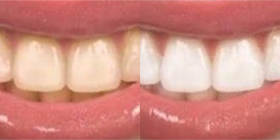 Facial before and after photo