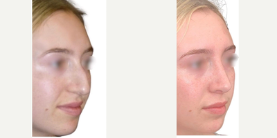 Rhinoplasty before and after photo