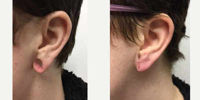 Earlobe Repair before and after photo
