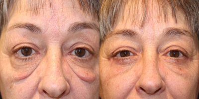 Eyelid Surgery before and after photo