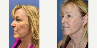 Facelift before and after photo
