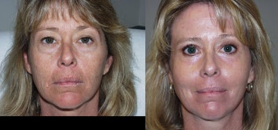 Facial Fat Transfer before and after photo