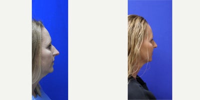 Rhinoplasty before and after photo