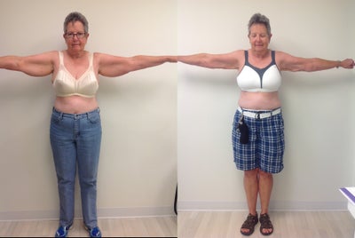 Smart Lipo before and after photo
