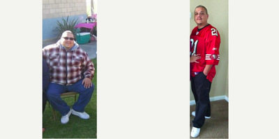 Gastric Sleeve Surgery before and after photo