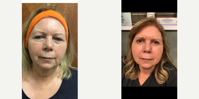 Laser Liposuction before and after photo