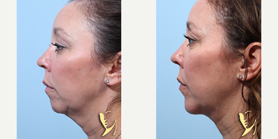 Neck Lift before and after photo