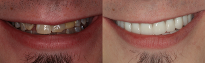 All-on-4 Dental Implants before and after photo