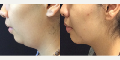 CoolSculpting before and after photo