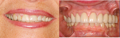 Dental Crown before and after photo