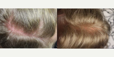 Hair Loss Treatment before and after photo