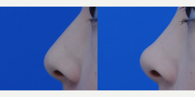 Nonsurgical Nose Job before and after photo