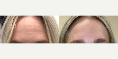 Botox before and after photo