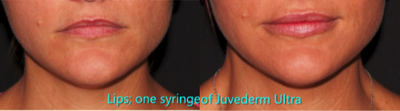Dermal Fillers before and after photo