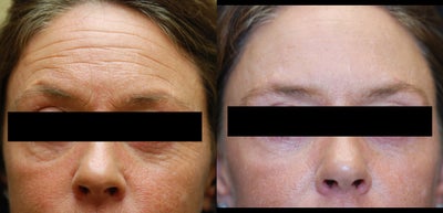 Dysport before and after photo