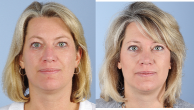 Eyelid Surgery before and after photo