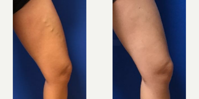 Sclerotherapy before and after photo