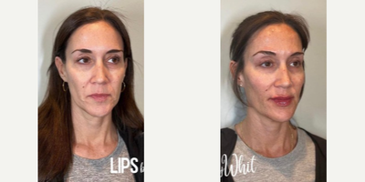 Cheek Fillers before and after photo