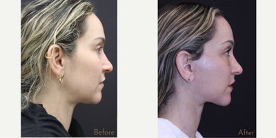 Endolift before and after photo