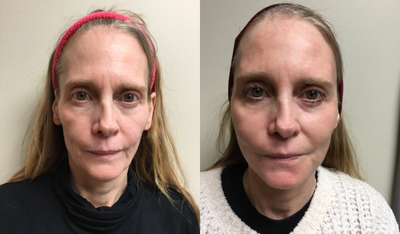 Facial Fat Transfer before and after photo