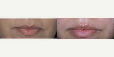 Lip Fillers before and after photo