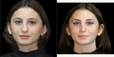Rhinoplasty before and after photo