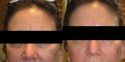 Voluma before and after photo