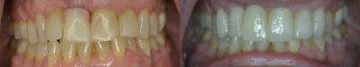 Dental Crown before and after photo