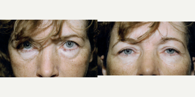 Eyelid Surgery before and after photo