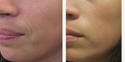 Volbella before and after photo