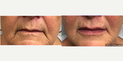 Volbella before and after photo