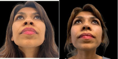 Asian Rhinoplasty before and after photo