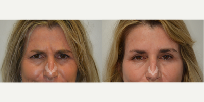 Botox before and after photo