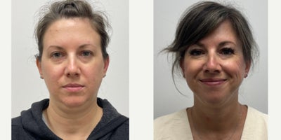 Chin Liposuction before and after photo