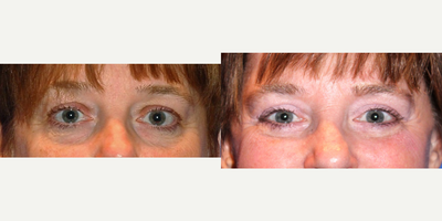 Eyelid Surgery before and after photo