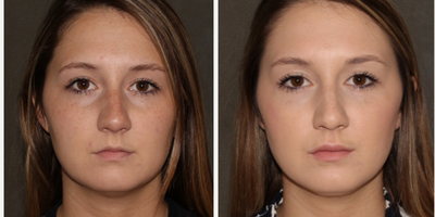 Eyelid Surgery before and after photo
