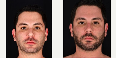 Fraxel Laser before and after photo
