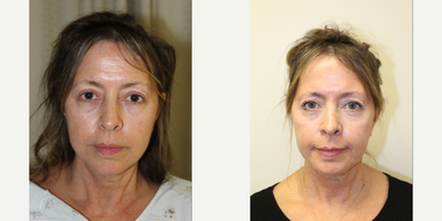 Laser Resurfacing before and after photo