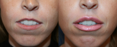 Lip Fillers before and after photo