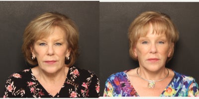 before and after image